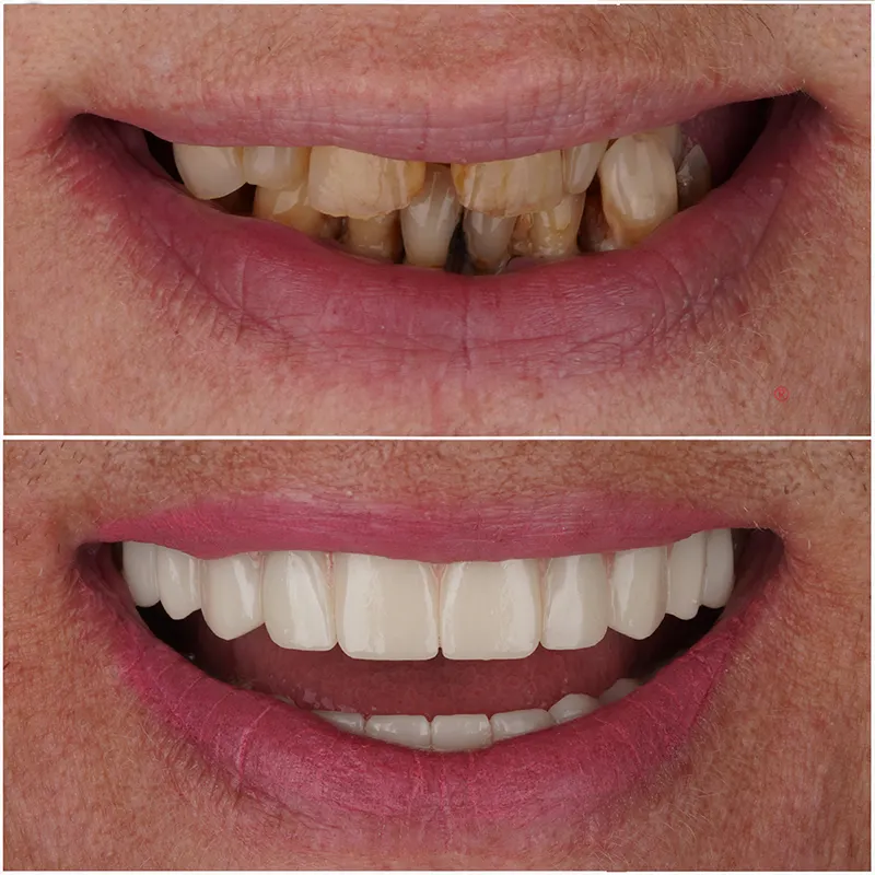 all-on-6-implant-turkey